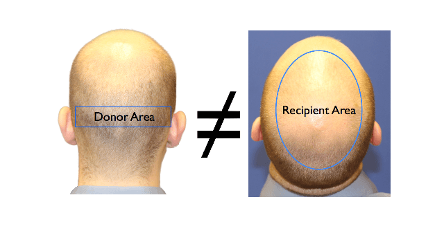 can a bald man get hair transplant
