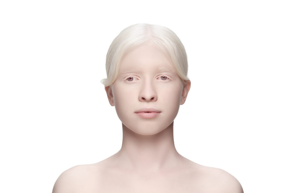 Can Albino People Dye Their Hair?