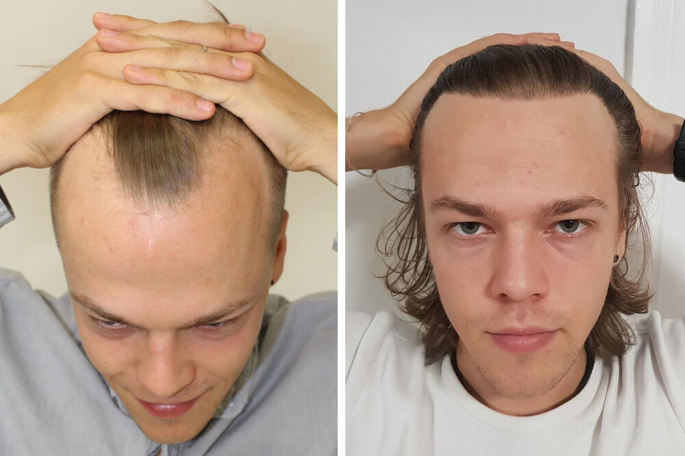 can hair transplant fix hairline