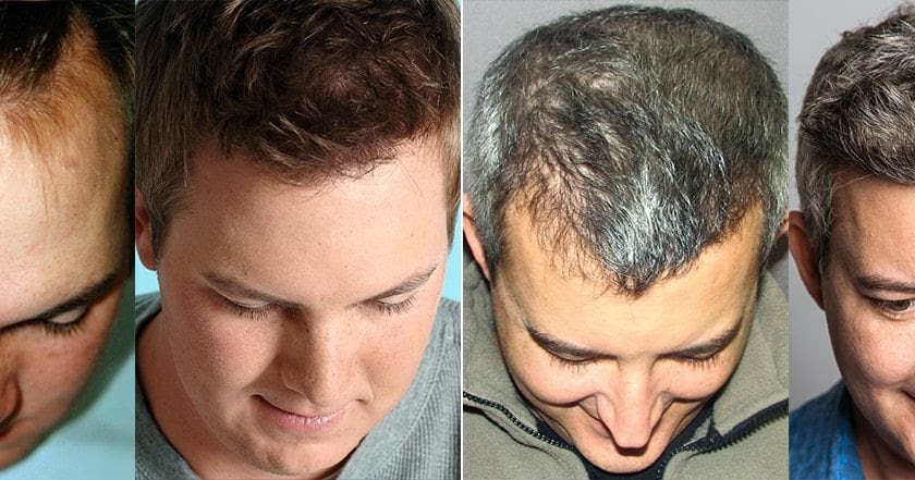Can You Get a Hair Transplant Using Hair From Someone Else?