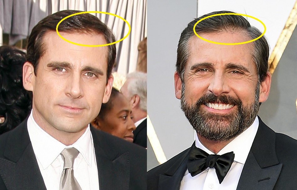 did steve carell get a hair transplant