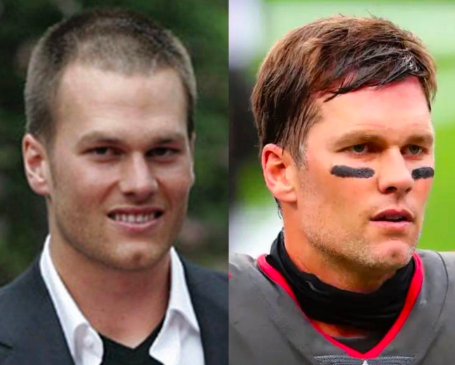 Did Tom Brady Get a Hair Transplant? Analyzing the NFL Star’s Remarkable Comeback from Baldness