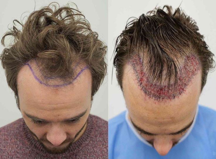 Do You Have to Shave Your Head for a Hair Transplant?