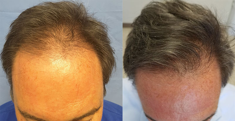do you have to take finasteride after hair transplant