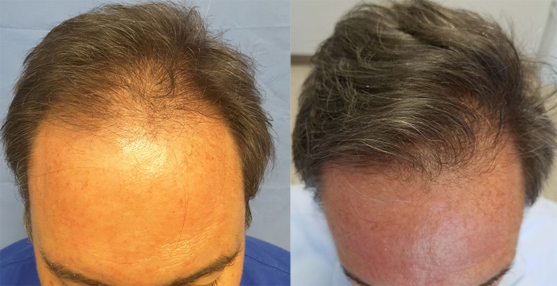 Do You Have to Take Finasteride After a Hair Transplant?