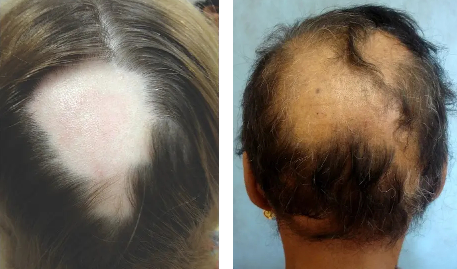 Do Hair Transplants Work for Alopecia? An In-Depth Look