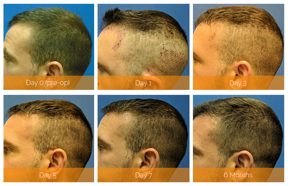 how long to recover from hair transplant