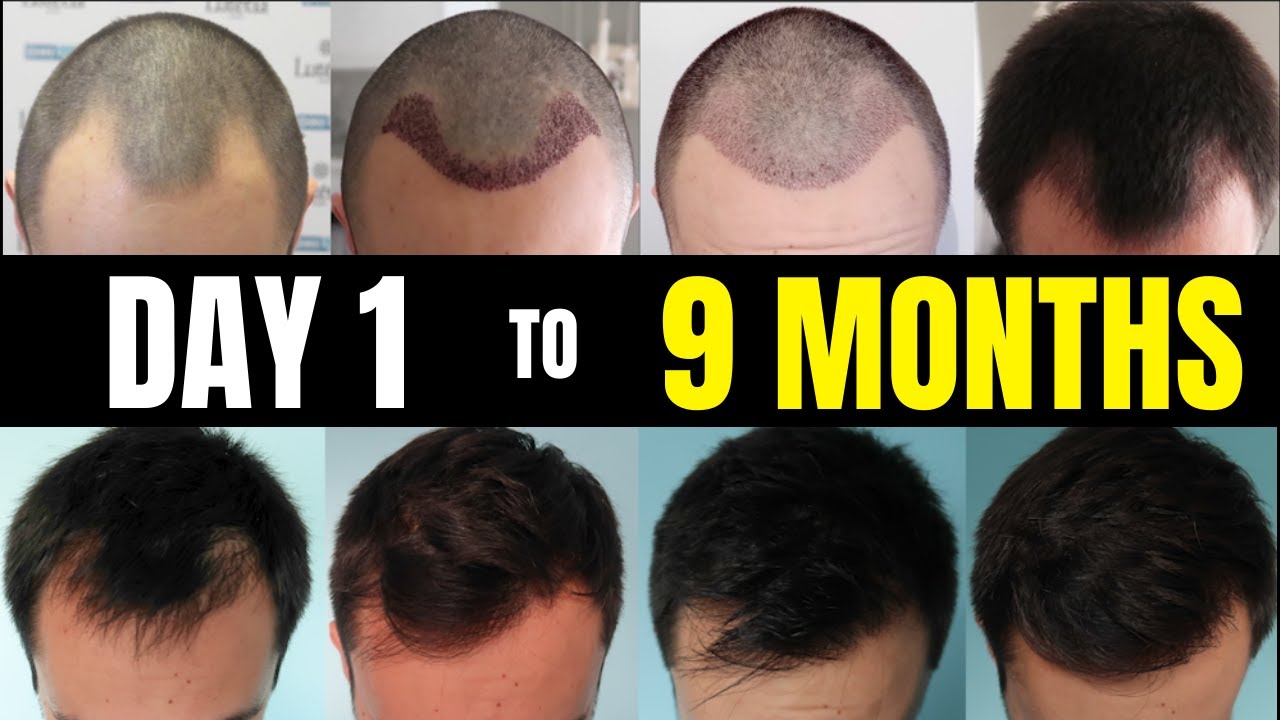 How Many Hair Transplants Can a Person Have?