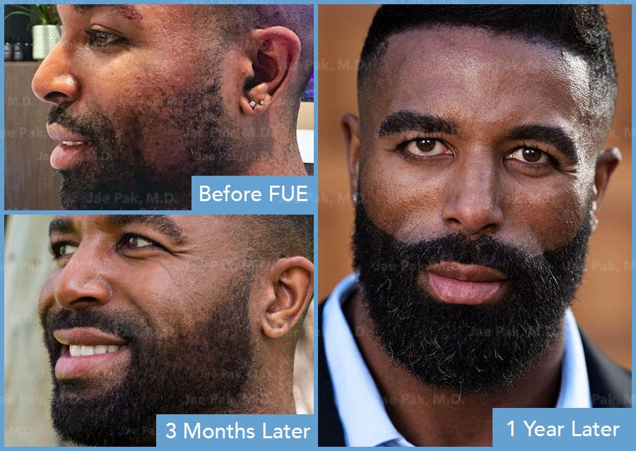 how much does a facial hair transplant cost