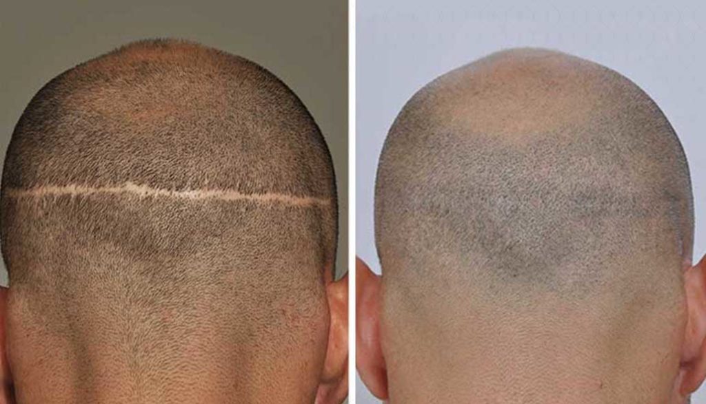 how much does fut hair transplant cost