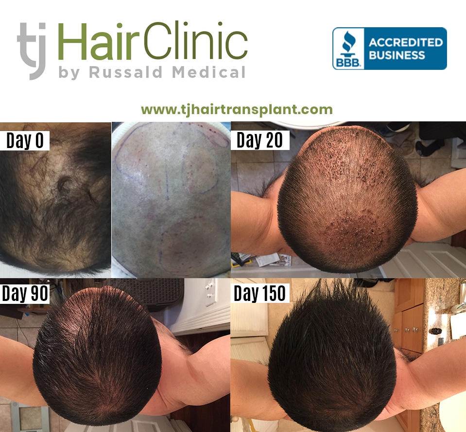How Much Is a Hair Transplant in Mexico? A Cost Breakdown