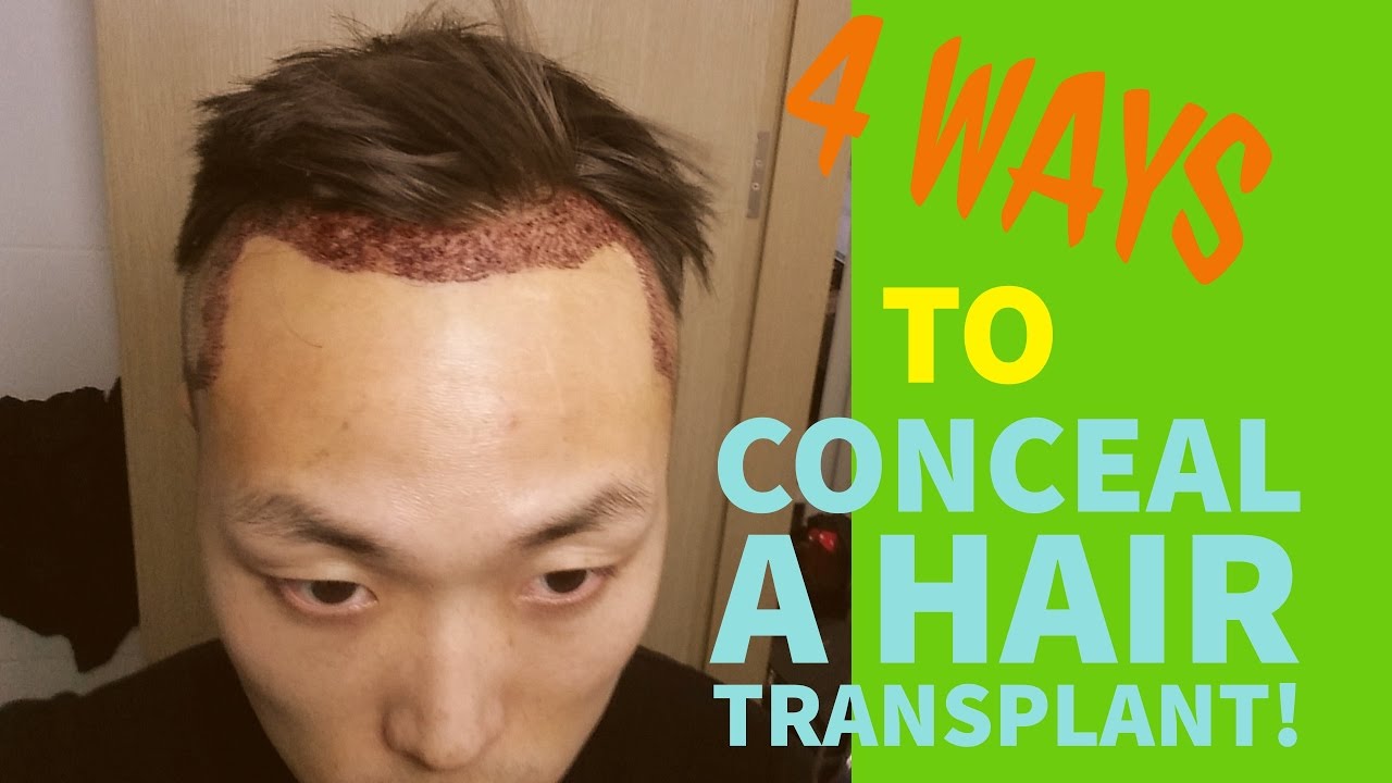 how to hide hair transplant