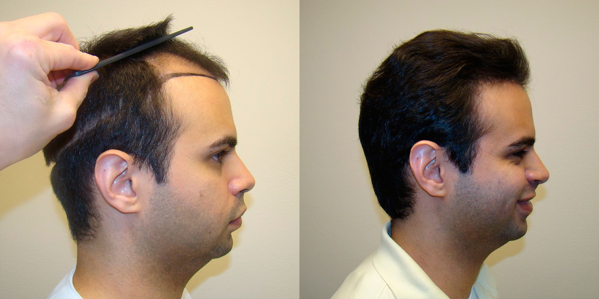 is hair transplant covered by insurance