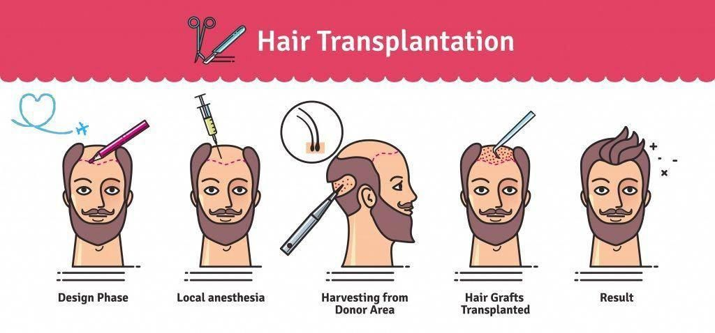 What is the Best Age to Get a Hair Transplant?