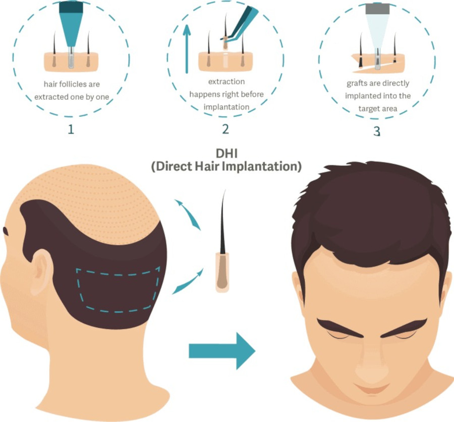 what is dhi hair transplant