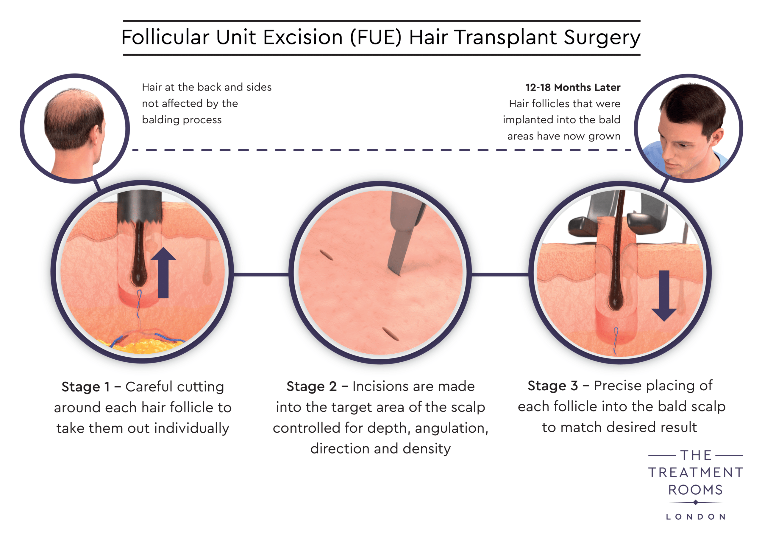 When Can I Rub My Head After a Hair Transplant?