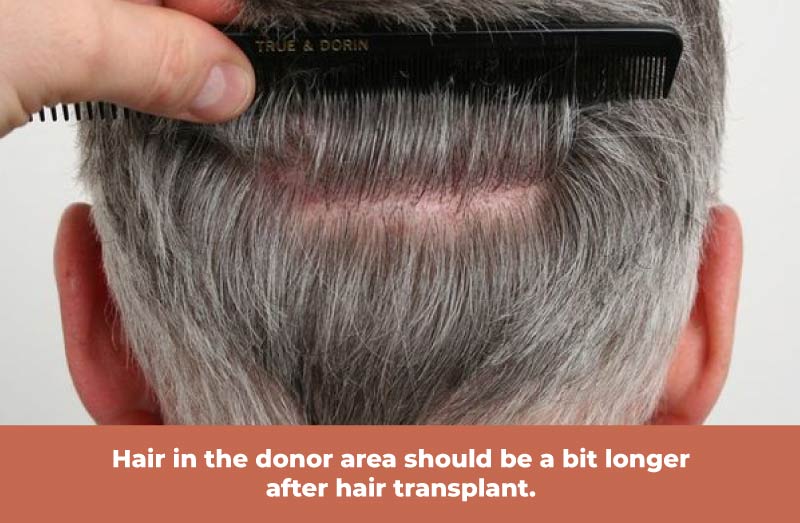 who should not do hair transplant