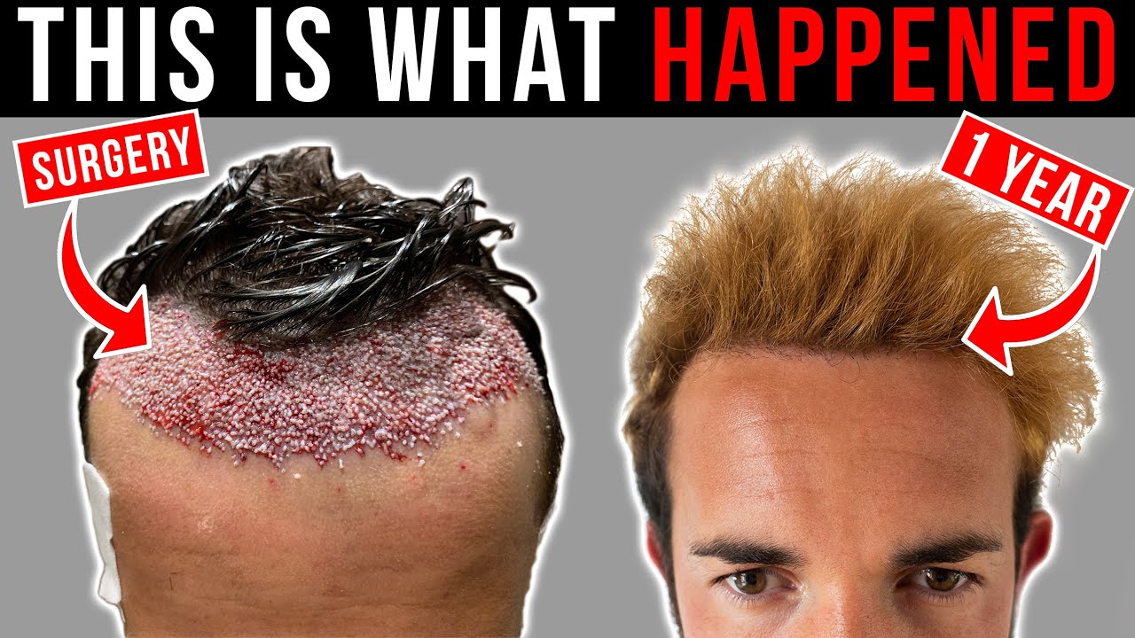 Are Hair Transplants in Turkey Safe? A Complete Guide