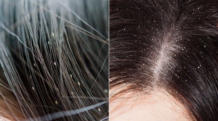 Will Hair Dye Kill Lice?